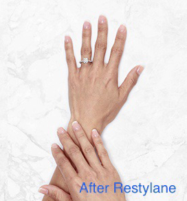 After Restylane