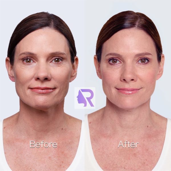 Instructions Before and After injection with facial fillers Reverza