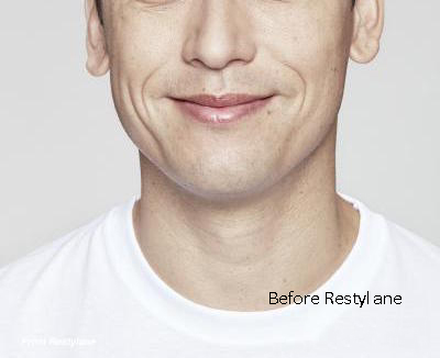 Before Rrestylane Final Before Rrestylane Final