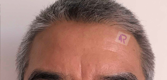 Botox After