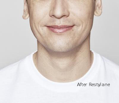 After Restylane After Restylane