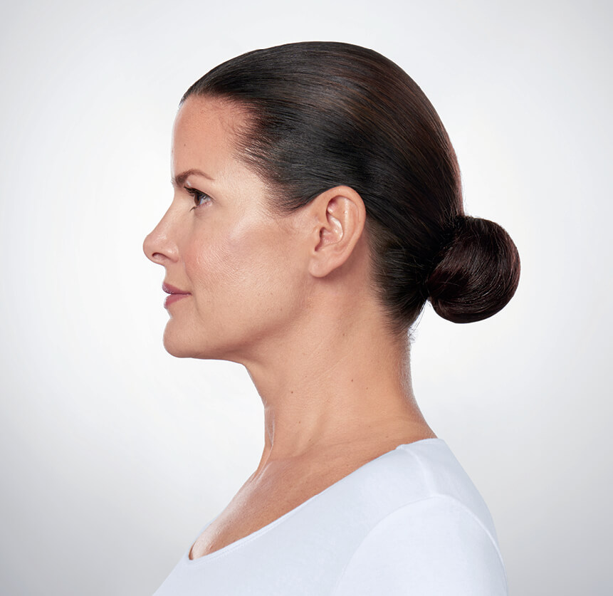 Kybella after Kybella after