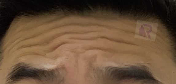 Before Botox
