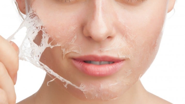 Chemical Peels