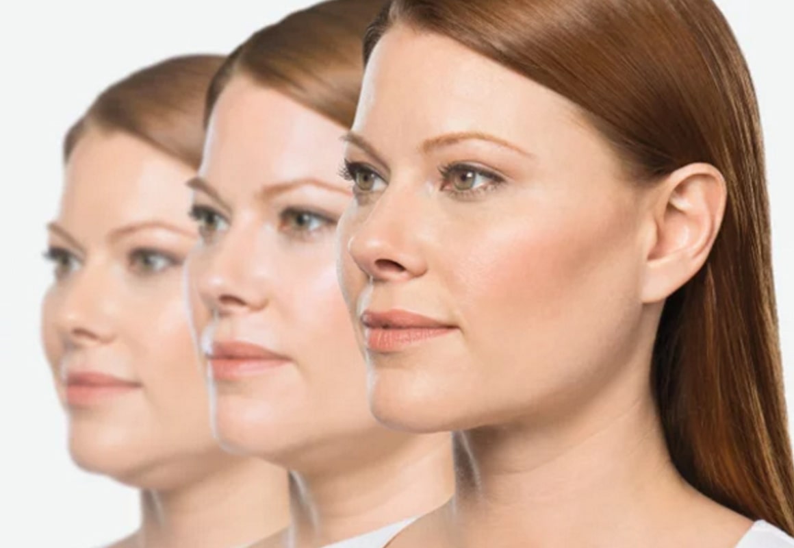 Kybella
