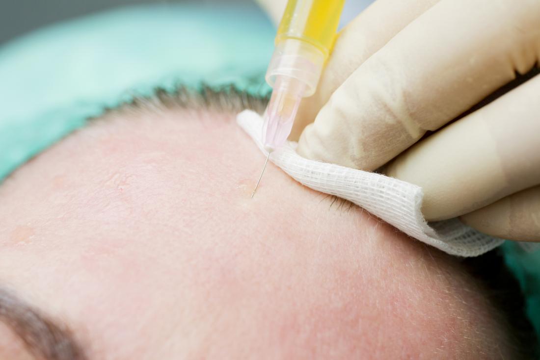 Platelet Rich Plasma