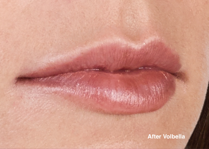 Lip Fillers Eugene Oregon Lip Fillers Eugene Oregon