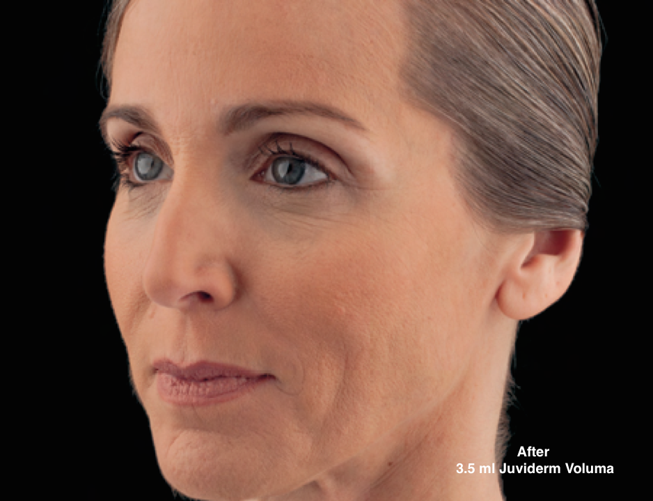 Juvederm Eugene Oregon Juvederm Eugene Oregon